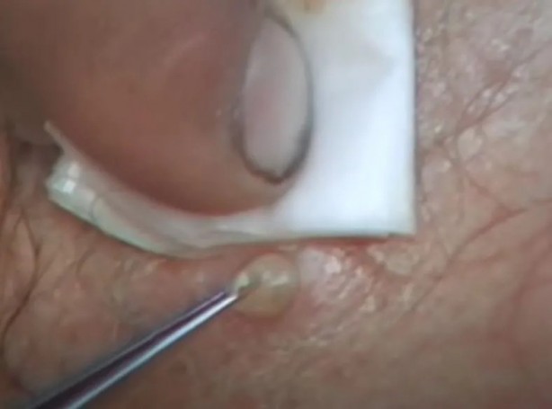 Foto - Sırtından çıkanlar görenleri şaşkına çevirdi! Sivilce zannettiği yaradan bakın ne çıktı