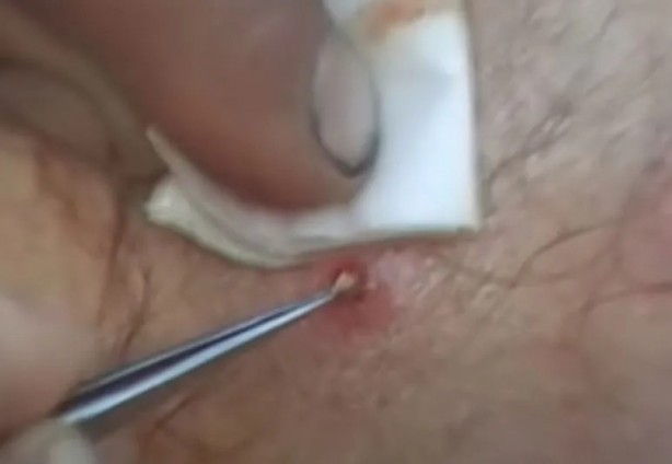 Foto - Sırtından çıkanlar görenleri şaşkına çevirdi! Sivilce zannettiği yaradan bakın ne çıktı