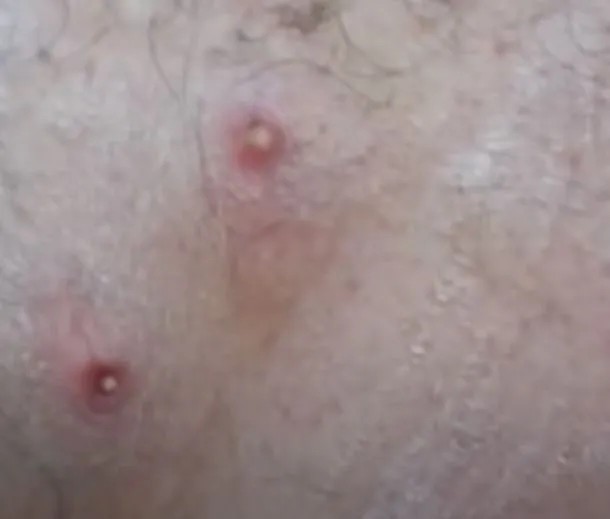 Foto - Sırtından çıkanlar görenleri şaşkına çevirdi! Sivilce zannettiği yaradan bakın ne çıktı