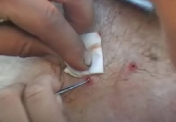 Foto - Sırtından çıkanlar görenleri şaşkına çevirdi! Sivilce zannettiği yaradan bakın ne çıktı