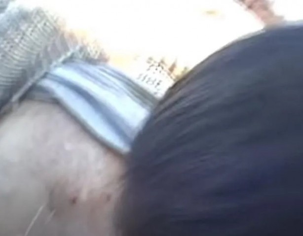 Foto - Sırtından çıkanlar görenleri şaşkına çevirdi! Sivilce zannettiği yaradan bakın ne çıktı