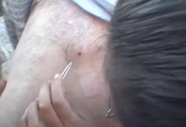 Foto - Sırtından çıkanlar görenleri şaşkına çevirdi! Sivilce zannettiği yaradan bakın ne çıktı