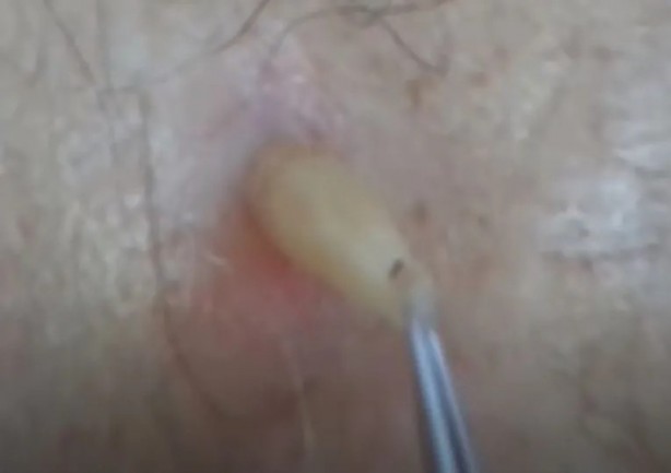 Foto - Sırtından çıkanlar görenleri şaşkına çevirdi! Sivilce zannettiği yaradan bakın ne çıktı