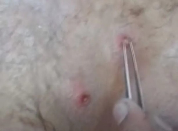 Foto - Sırtından çıkanlar görenleri şaşkına çevirdi! Sivilce zannettiği yaradan bakın ne çıktı