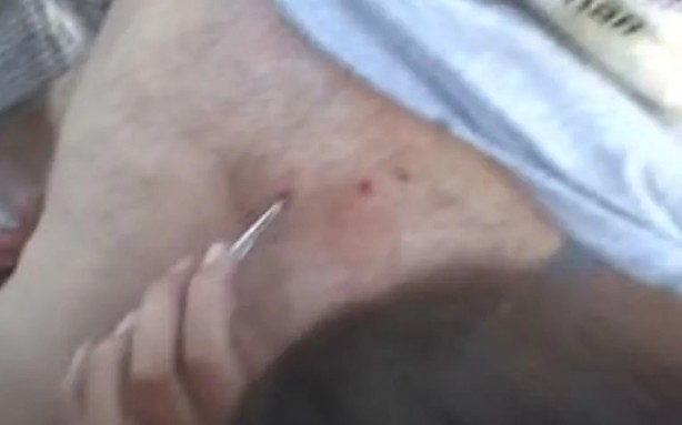 Foto - Sırtından çıkanlar görenleri şaşkına çevirdi! Sivilce zannettiği yaradan bakın ne çıktı