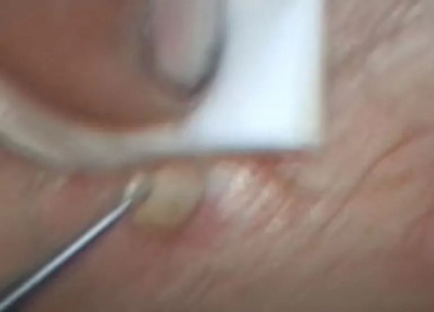 Foto - Sırtından çıkanlar görenleri şaşkına çevirdi! Sivilce zannettiği yaradan bakın ne çıktı