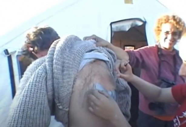 Foto - Sırtından çıkanlar görenleri şaşkına çevirdi! Sivilce zannettiği yaradan bakın ne çıktı