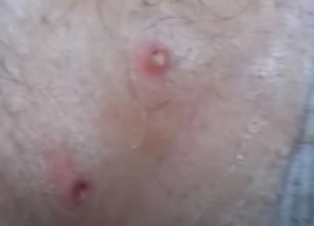 Foto - Sırtından çıkanlar görenleri şaşkına çevirdi! Sivilce zannettiği yaradan bakın ne çıktı