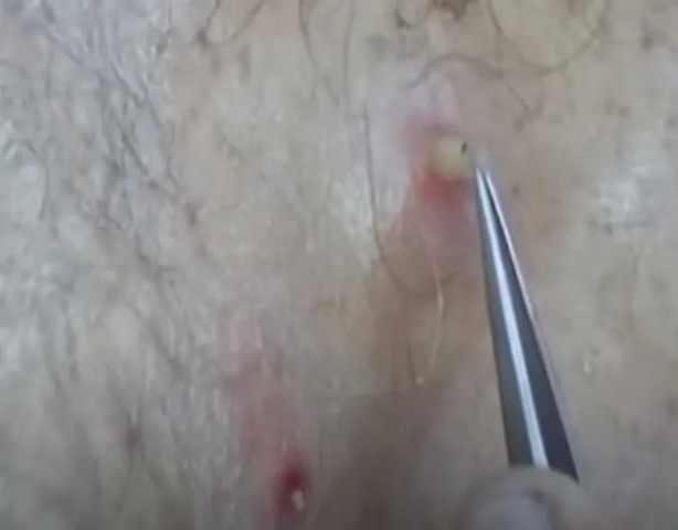 Foto - Sırtından çıkanlar görenleri şaşkına çevirdi! Sivilce zannettiği yaradan bakın ne çıktı