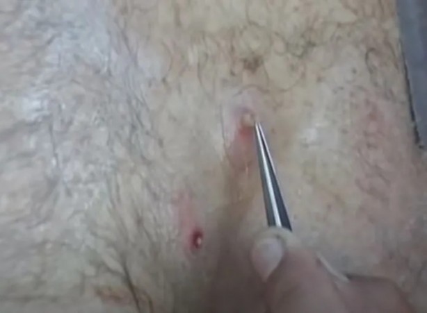 Foto - Sırtından çıkanlar görenleri şaşkına çevirdi! Sivilce zannettiği yaradan bakın ne çıktı