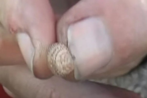 Foto - Sırtından çıkanlar görenleri şaşkına çevirdi! Sivilce zannettiği yaradan bakın ne çıktı