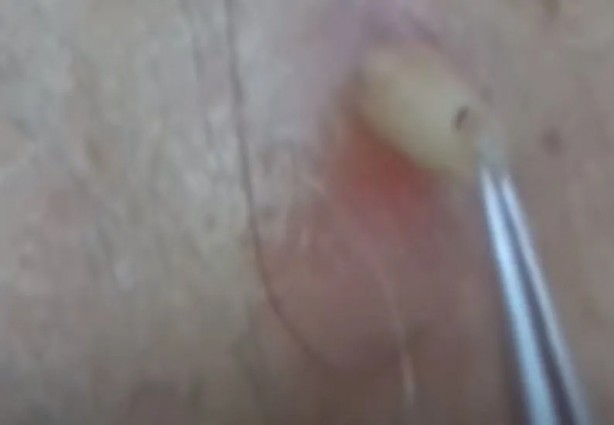 Foto - Sırtından çıkanlar görenleri şaşkına çevirdi! Sivilce zannettiği yaradan bakın ne çıktı