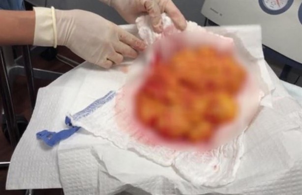 Foto - Sırtından çıkanlar hayrete düşürdü