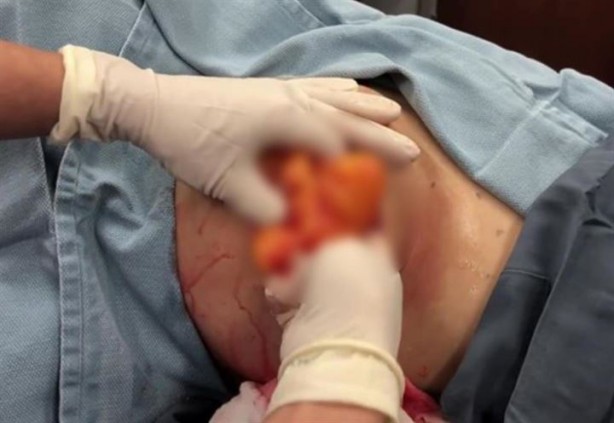 Foto - Sırtından çıkanlar hayrete düşürdü