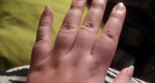 Foto - Şişmiş ellerle uyanıyorsanız, bu 7 hastalığın habercisi olabilir