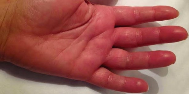 Foto - Şişmiş ellerle uyanıyorsanız, bu 7 hastalığın habercisi olabilir