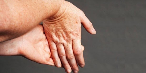 Foto - Şişmiş ellerle uyanıyorsanız, bu 7 hastalığın habercisi olabilir