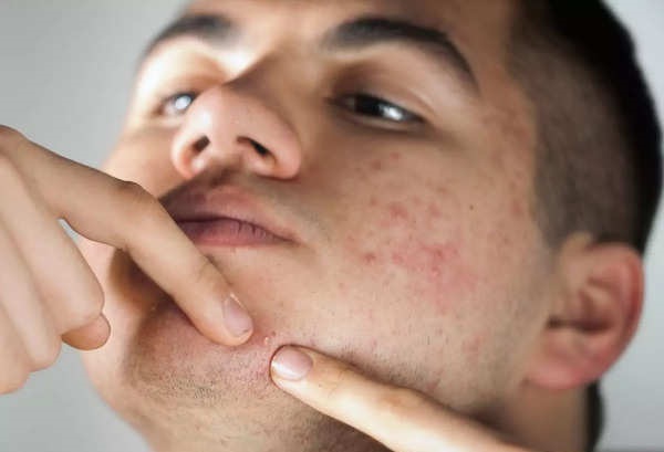 Foto - Sivilce deyip geçmeyin! Bu hata sivilcelerin tedavisini imkansız hale getiriyor