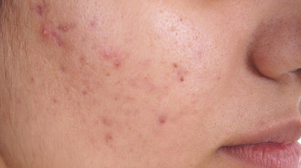 Foto - Sivilce deyip geçmeyin! Bu hata sivilcelerin tedavisini imkansız hale getiriyor