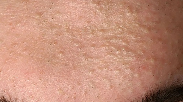 Foto - Sivilce deyip geçmeyin! Bu hata sivilcelerin tedavisini imkansız hale getiriyor