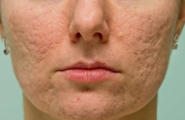 Foto - Sivilce deyip geçmeyin! Bu hata sivilcelerin tedavisini imkansız hale getiriyor