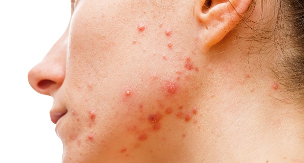 Foto - Sivilce deyip geçmeyin! Bu hata sivilcelerin tedavisini imkansız hale getiriyor