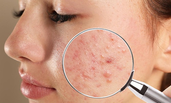 Foto - Sivilce deyip geçmeyin! Bu hata sivilcelerin tedavisini imkansız hale getiriyor