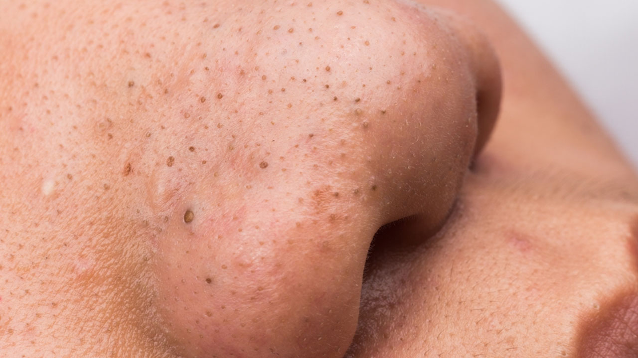 Foto - Sivilceleri sıkanlar dikkat! Kanser olabilirsiniz