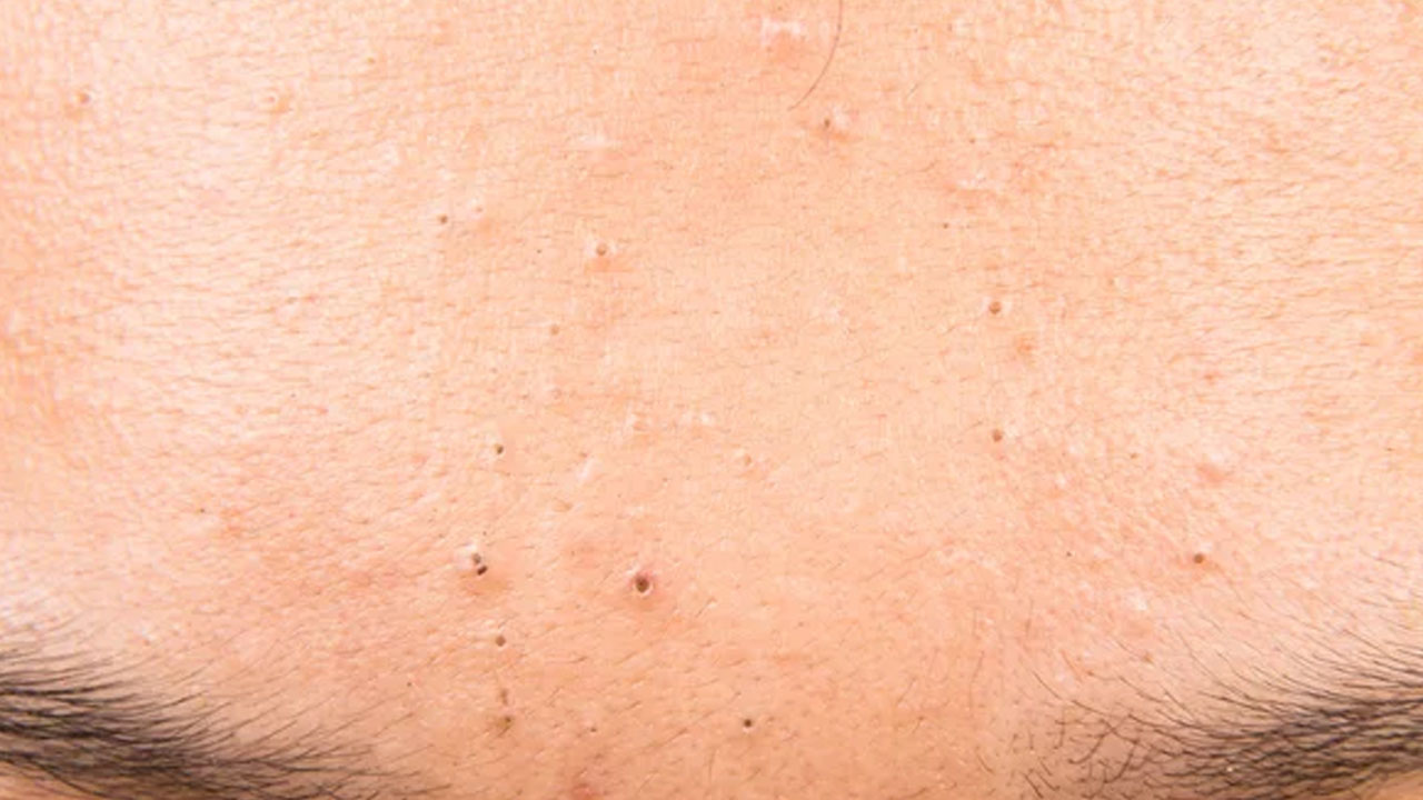 Foto - Sivilceleri sıkanlar dikkat! Kanser olabilirsiniz