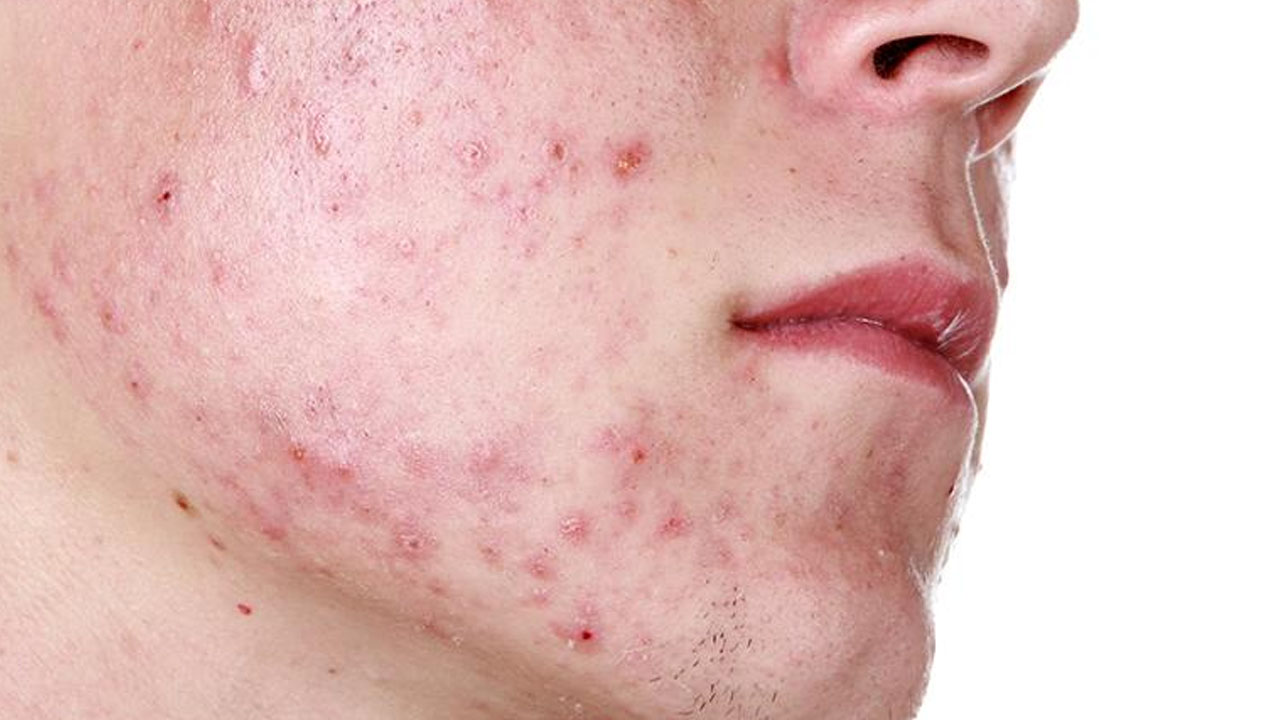 Foto - Sivilceleri sıkanlar dikkat! Kanser olabilirsiniz