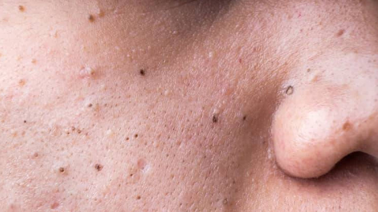 Foto - Sivilceleri sıkanlar dikkat! Kanser olabilirsiniz