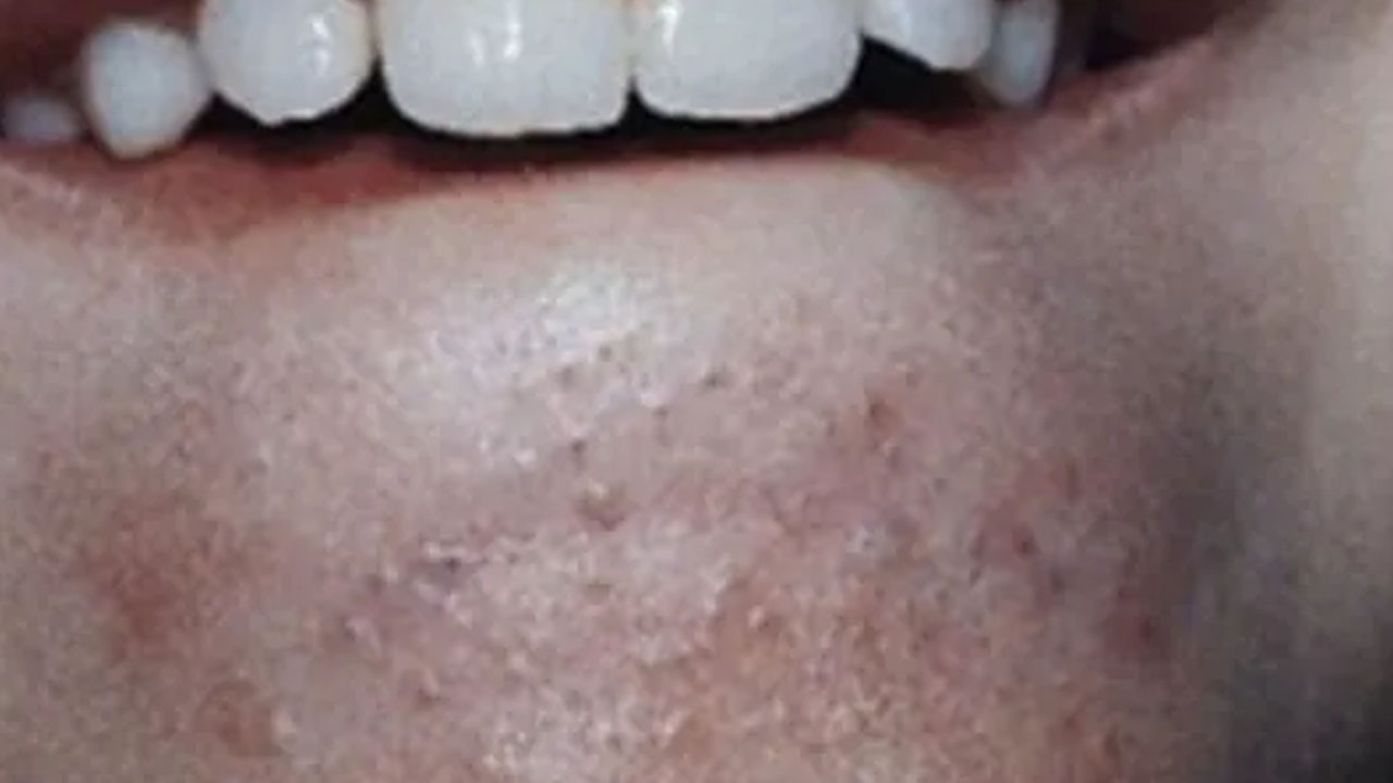 Foto - Sivilceleri sıkanlar dikkat! Kanser olabilirsiniz