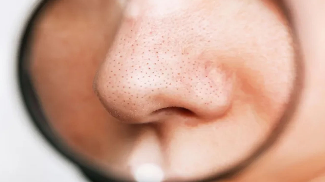  Sivilceleri sıkanlar dikkat! Kanser olabilirsiniz