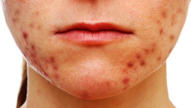 Sivilceleri azaltan10 yiyecek