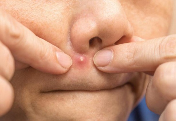 Sivilcesini patlattı! Beyni iltihapla doldu