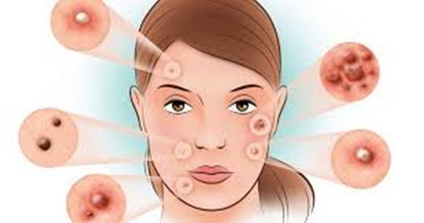 Foto - Sivilceye bunlar sebep oluyor!