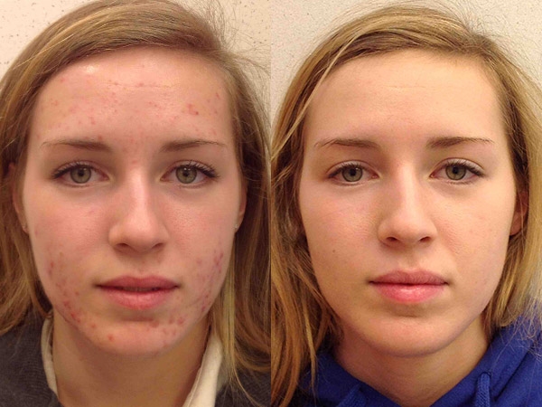 Foto - Sivilceye bunlar sebep oluyor!