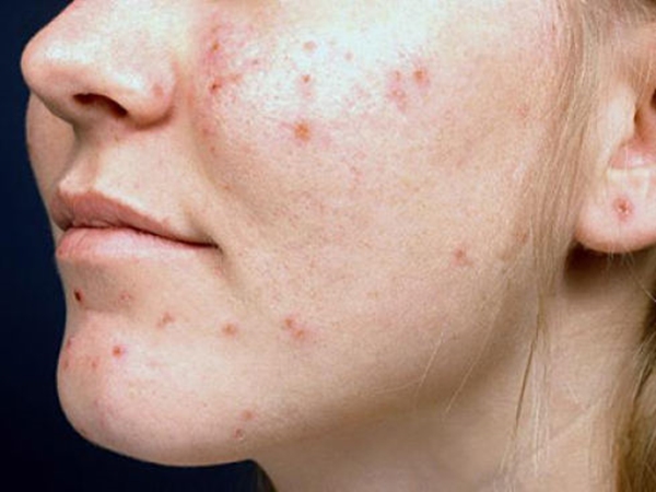 Foto - Sivilceye bunlar sebep oluyor!