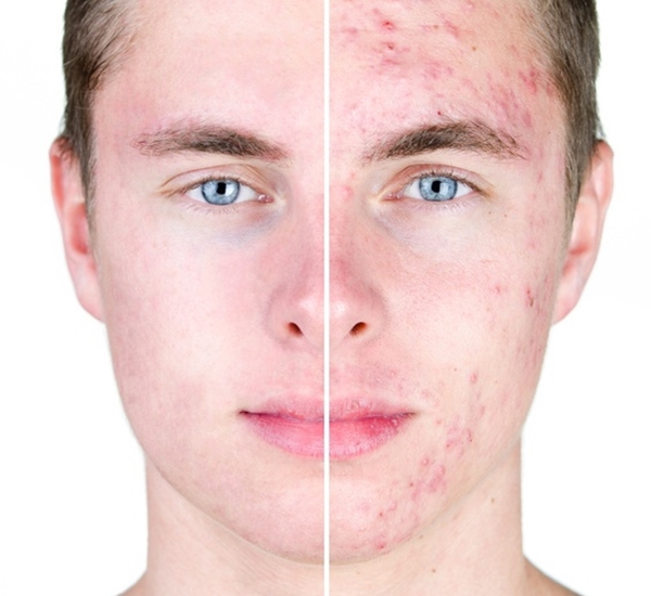 Sivilceye bunlar sebep oluyor!