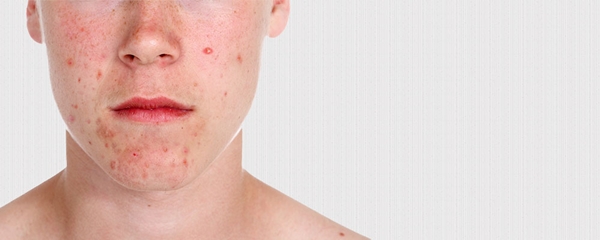 Foto - Sivilceye bunlar sebep oluyor!