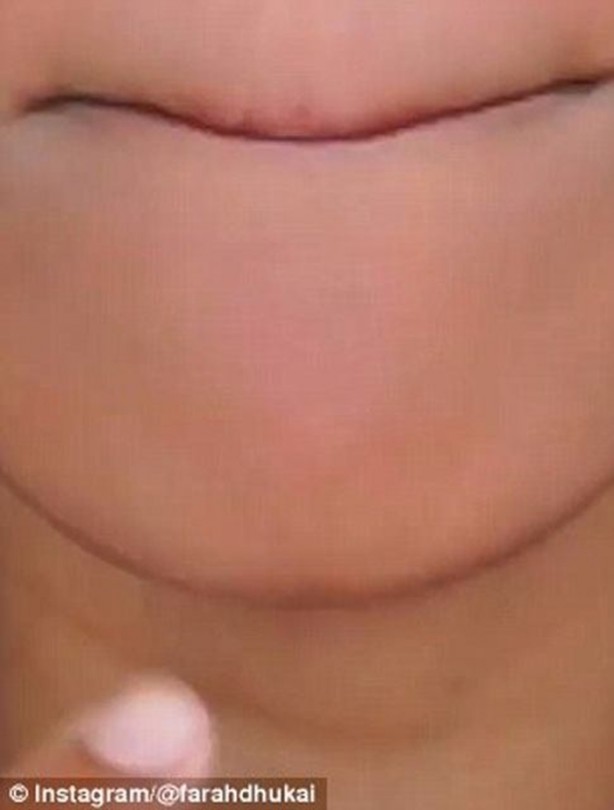 Foto - Sivilceyi 1 gecede geçirin!