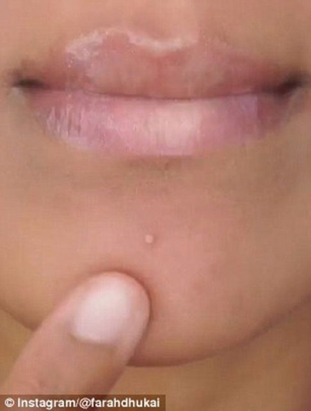 Foto - Sivilceyi 1 gecede geçirin!