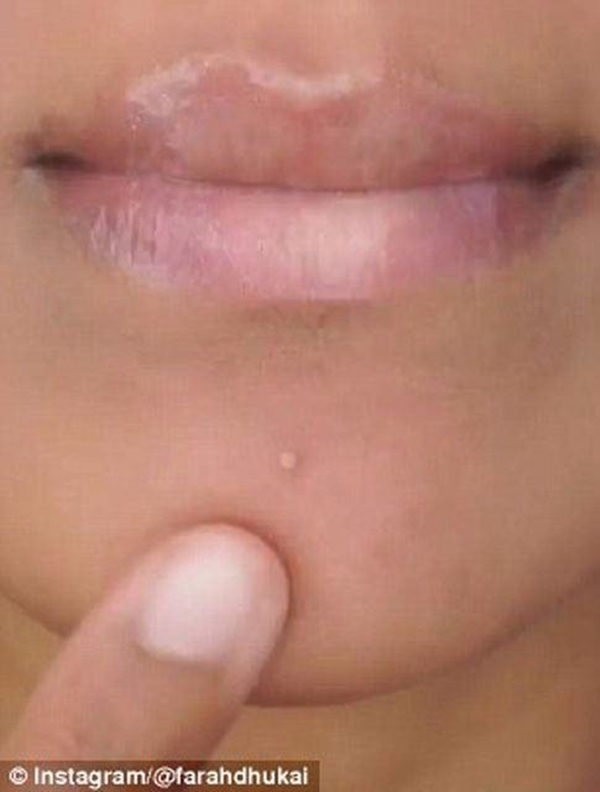 Foto - Sivilceyi 1 gecede geçirmek mümkün!