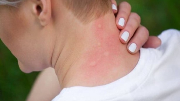 Foto - Sivrisinek ısırığı artık kabusunuz olmayacak! Şakkadanak kesip atıyor! Bunu yapın, "Dünya varmış" deyin