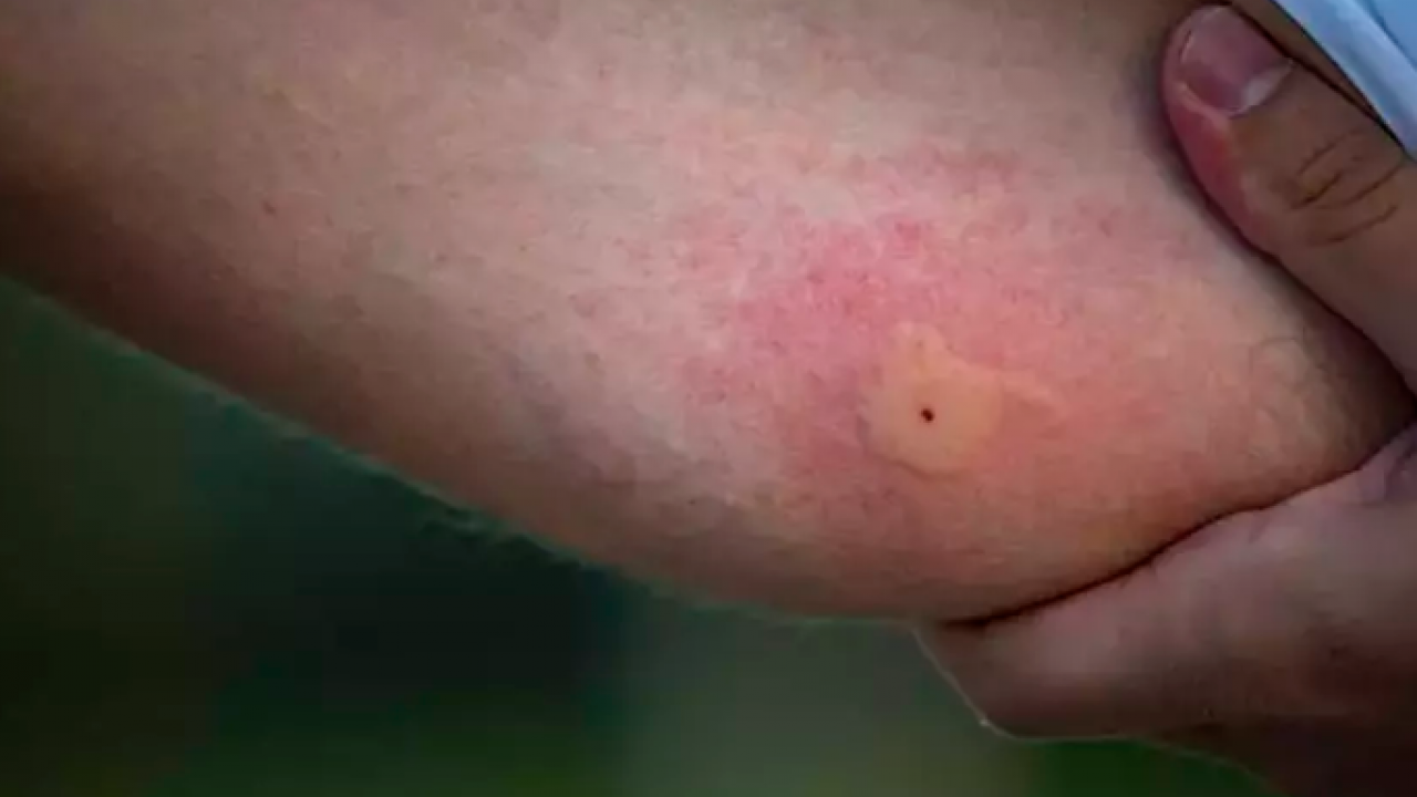 Foto - Sivrisinekler Neden Hep Sizi Isırıyor? Sebebi Kan Grubunuz Değil!