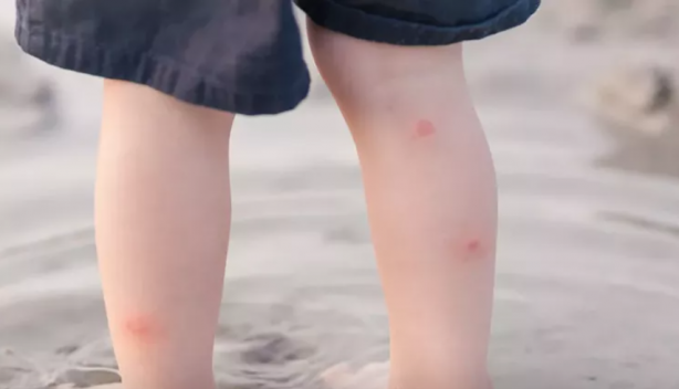 Foto - Sivrisinekten nasıl korunulur? Sağlık Bakanlığı'ndan korunma rehberi