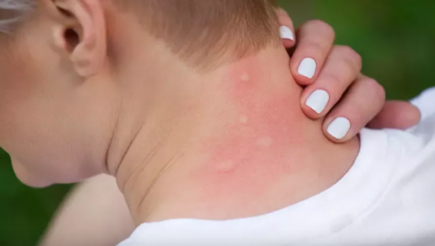 Foto - Sivrisinekten nasıl korunulur? Sağlık Bakanlığı'ndan korunma rehberi