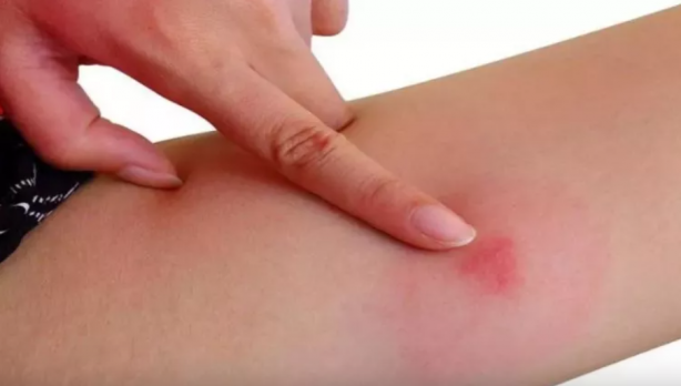 Foto - Sivrisinekten nasıl korunulur? Sağlık Bakanlığı'ndan korunma rehberi