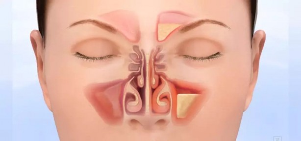 Foto - Siyah noktalarını sıkanlar dikkat!