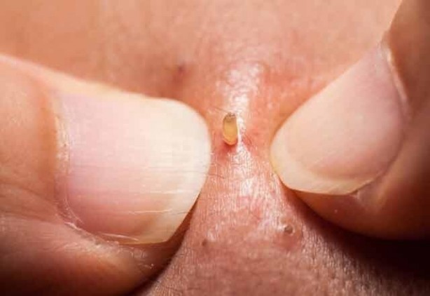 Foto - Siyah noktalarını sıkanlar dikkat!